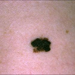 Example of skinCancerAndMelanomas